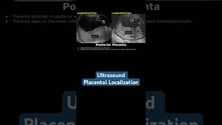 Ultrasound placental localization ultrasound doctor mbbs pregancyultrasound baby [upl. by Mozes605]