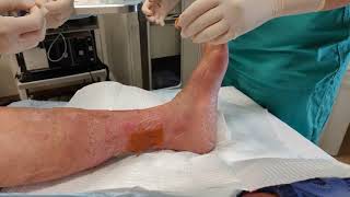 Venous Stasis Ulcer Bandaging and Dressing [upl. by Cazzie]