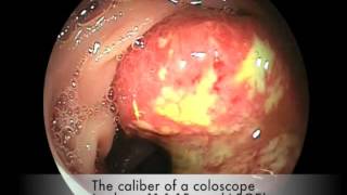 Stenotic colon cancer [upl. by Greggory816]