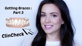 Getting Braces  Part 3  ClinCheck [upl. by Lebiram]