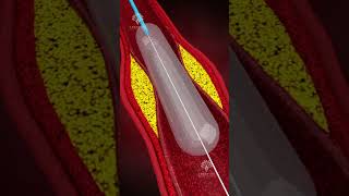 How Does Coronary Angioplasty Work  Blocked Arteries Treatment shorts  creativelearning3d [upl. by Chilcote]