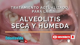 Tratamiento Actualizado para la Alveolitis Seca y Húmeda Limpieza Medicación y Apósitos [upl. by Sabra]