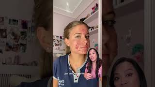 💕 this Severe acne vulgaris and SUCCESS with Accutane aka isotretinoin [upl. by Emelen]