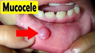 How to cure Mucocele  Home Remedies for a Mucocele [upl. by Eocsor710]