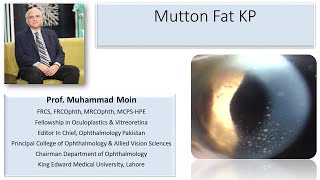 Mutton Fat Keratic Precipitates [upl. by Nolla123]