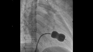 percutaneous mitral commissurotomy part II [upl. by Anilegna]