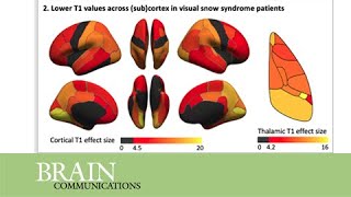 Microstructure in patients with visual snow syndrome [upl. by Aguayo205]