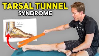 5 Home Exercises for Tarsal Tunnel Syndrome [upl. by Dixil]