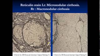 pathology  dr Dhaymaa  Liver cirrhosis amp Jaundice الكبد [upl. by Airdnekal]