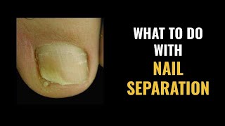 NAIL SEPARATION  What to DO and What are the CAUSES [upl. by Kerad]