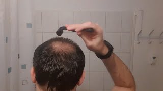 Minoxidil  Derma Roller Results I 4 Months Update [upl. by Ramah904]