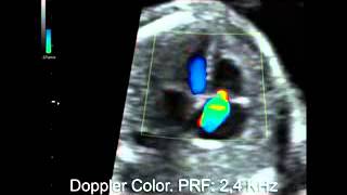 Insuficiencia tricuspidea Doppler Color Manipulando el PRF [upl. by Leod902]