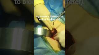 Demonstration of anterior abdominal extraperitoneal approach on the lower part of right ureter [upl. by Faun]