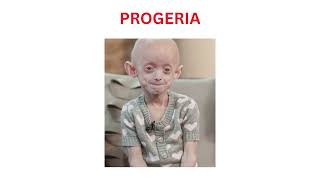 PROGERIA A MEDICAL MYSTERY OF AGING [upl. by Haymo938]