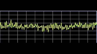 Asperger Syndrome  Rife Frequencies [upl. by Inavoj]