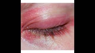 Blepharitis Symptoms and Causes  Diagnosis  Treatment  Prevention health [upl. by Sheridan]