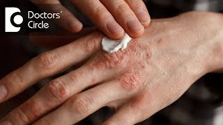 What is included in topical treatment for PsoriasisDr Sravya Tipirneni [upl. by Eilsek]