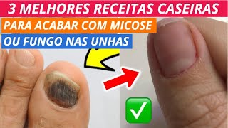 CONHEÇA 3 MELHORES RECEITAS CASEIRAS PARA ACABAR COM MICOSE OU FUNGO NAS UNHAS [upl. by Hollinger86]