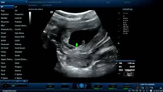 Non viable embryo with retroplacental hematoma Diagnostic ultrasound cases [upl. by Austina]