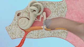 Clogged Ear Due to Ear Infection or Eustachian Tube Dysfunction [upl. by Elatsyrc]