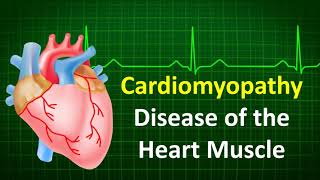 Cardiomyopathy Disease of the Heart Muscle [upl. by Trebreh589]