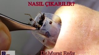 Silikon Burun Tamponu Nasıl Çıkarılır Nasal Splint Removal [upl. by Sarazen968]