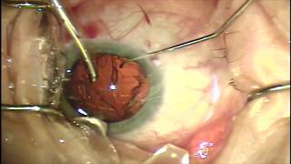 Toric IOL implantation with intraoperative surprise [upl. by Lamahj]