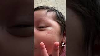 Como quitar los granitos en la cara de los bebes piel atopica o dermatitis en bebes recien nacidos [upl. by Thurber735]