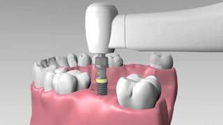 AIDI Biomedical  Implant Pack Placement Procedure [upl. by Ahsitam]