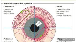 Conjunctiva  Red eye  Conjunctival and Ciliary Congestion  Ophthalmology [upl. by Gurango]