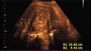 Sonographic prediction of a large intramural fibroid [upl. by Donall]