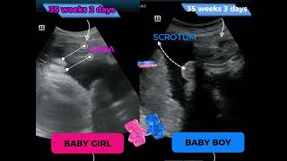 Baby Boy  Baby girl  both at 35 Weeks  ultrasound [upl. by Bein]