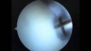 Knee arthroscopy  OCD Mosaicplasty [upl. by Housum]