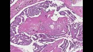 Histopathology BreastDuctal carcinoma in situ [upl. by Austreng]