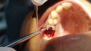 Crown Broke During Extraction How to Extract Rest of The Root Pieces [upl. by Prinz]