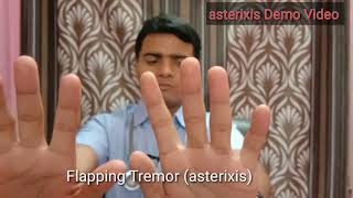 Asterixis Flapping tremor AKA  Hepatic encephalopathy [upl. by Rosemonde532]