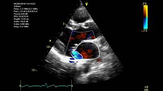 Echocardiographic assessment of the mitral valve [upl. by Annavahs]