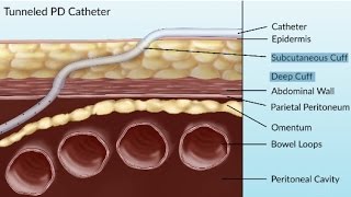 Complications of Peritoneal Dialysis by S Su  OPENPediatrics [upl. by Anerat]