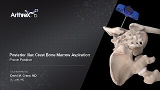 Posterior Iliac Crest Bone Marrow Aspiration  Prone Position [upl. by Garland]