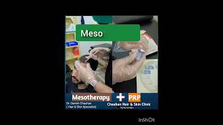 Mesotherapy For Hair Regrowth। HairFall hairloss baldness PRPGFC [upl. by Huberman]