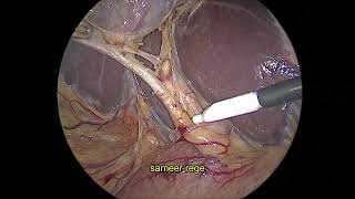 Laparoscopic Calots triangle dissection [upl. by Lynette]