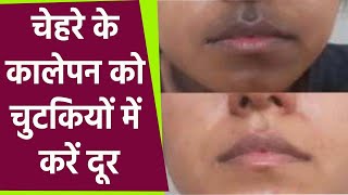 मुंह के आसपास कालापन दूर करने का बेहद सस्‍ता तरीका । Get Rid Of Dark Patches Around The Mouth [upl. by Okorih]