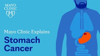 Mayo Clinic explains stomach cancer [upl. by Nosyk]