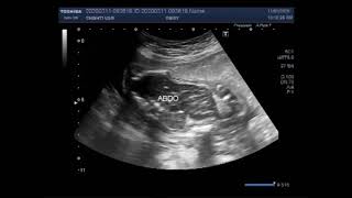 Ultrasound Video showing Pregnancy with fetal demise and positive Spalding sign [upl. by Ahsehat183]