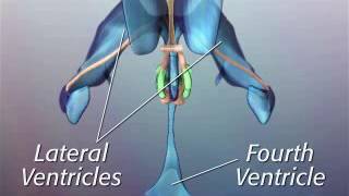 Anatomy of Hypothalamic Hamartoma [upl. by Nollad138]