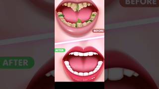 ASMR DENTAL CLEANING AND throat stone removal animation ASMR [upl. by Eartha]