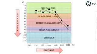 Kako pročitati audiogram [upl. by Jillana]