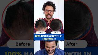 100 Hair Regrowth in 4 Months  Hair Loss  Hair Regrowth  Hair Fall  Adon Hair Care viral [upl. by Asserrac640]