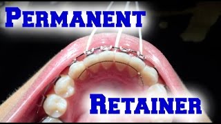 Braces Update Permanent Retainer [upl. by Hinman300]