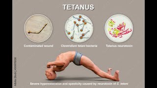 Tetanus  What is Tetanus  Cause symptoms treatment amp prevention of Tetanus [upl. by Ahsieat749]